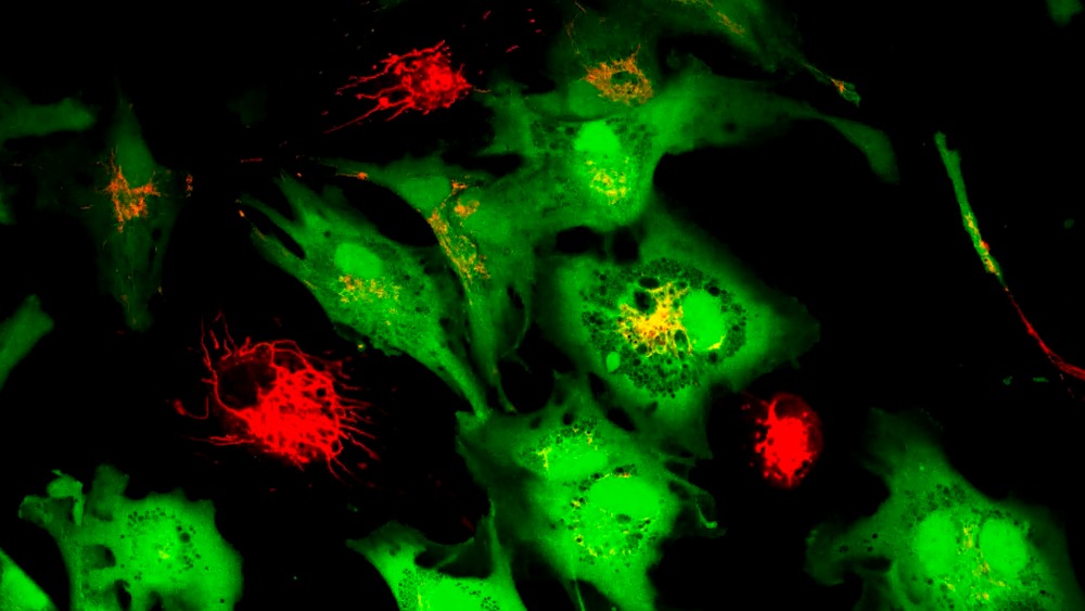 A microscopic image of cancer cells