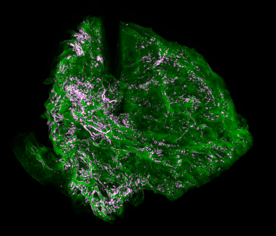 A closeup image of a cancer cell.