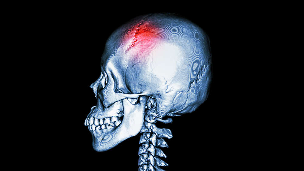 A picture of a skull with  a fracture