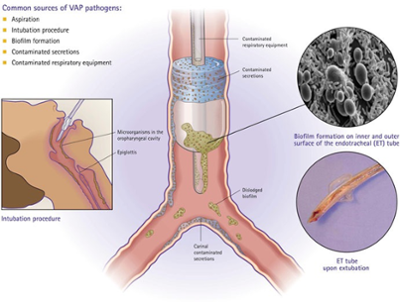 Diagram of the throat showing how bacteria grows on a tube when it's inserted.