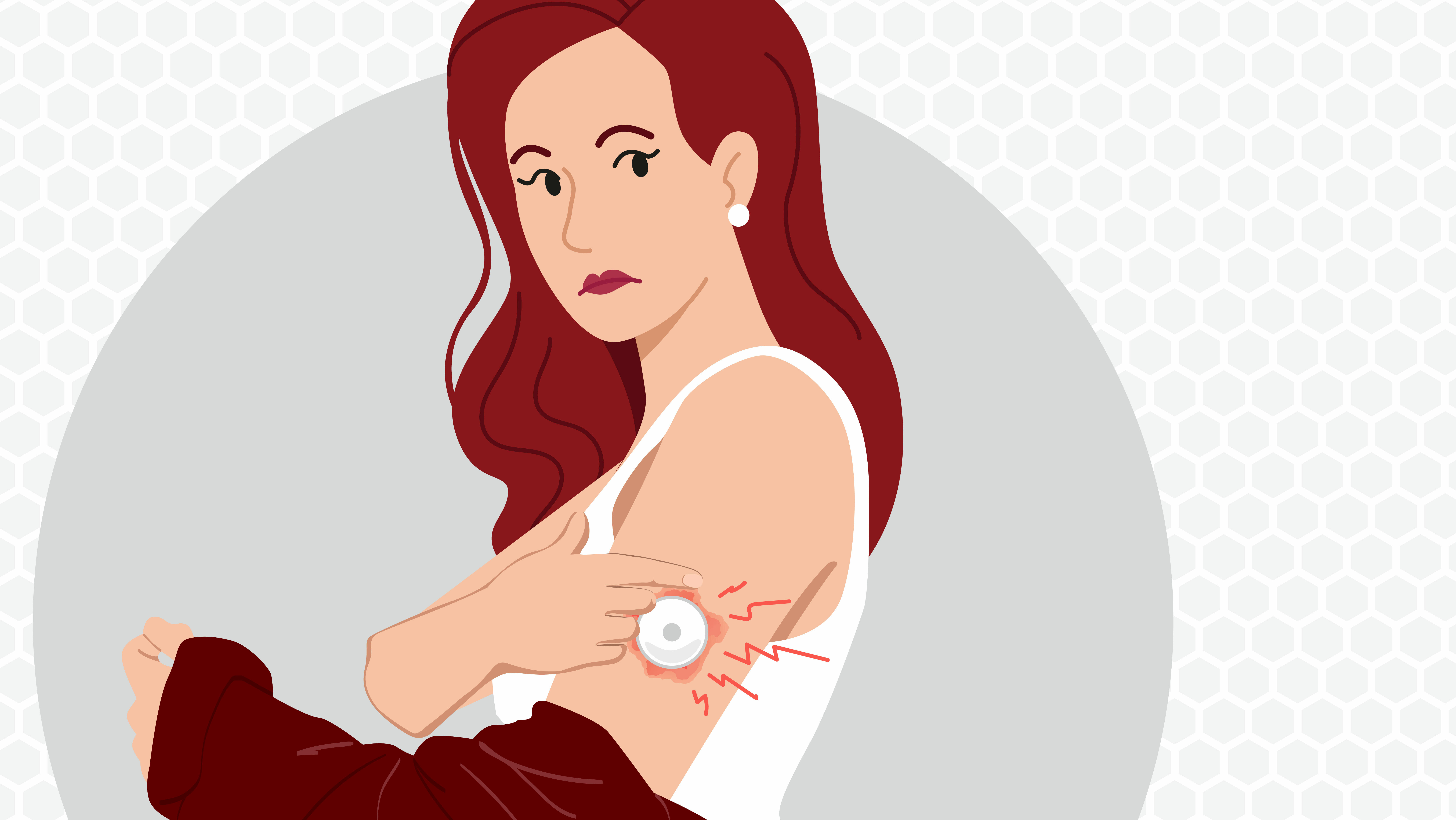 A person with irritated skin on her arm from wearing a glucose monitor.  