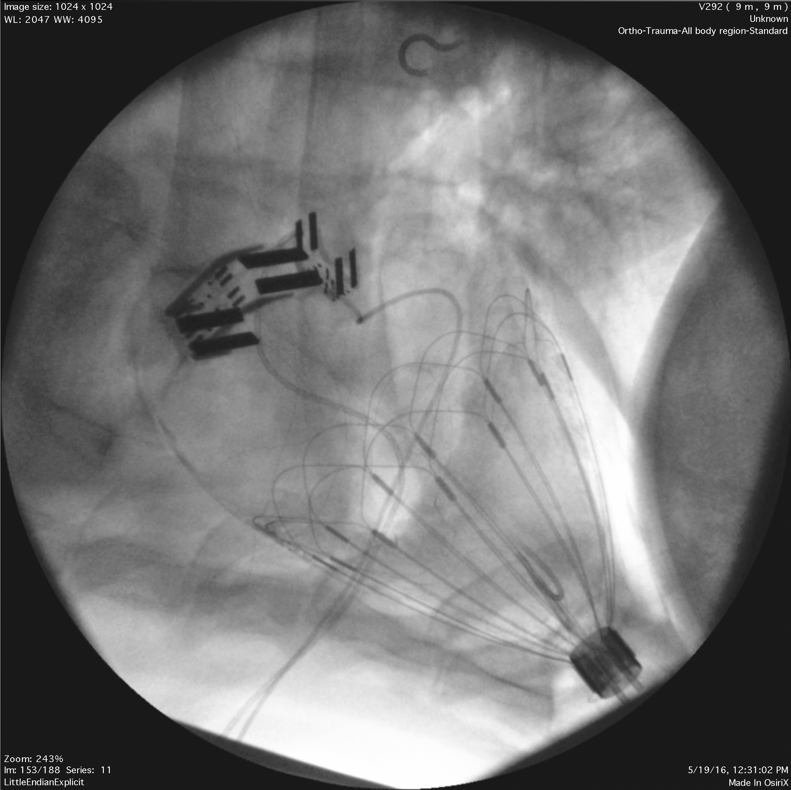 A black and white medical scan shows an expanding mechanical device inside a patient’s body.