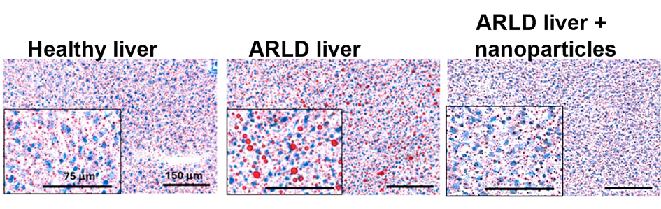 An image showing three different mouse livers as healthy liver, ARLD liver, and ARLD liver plus nanoparticles.